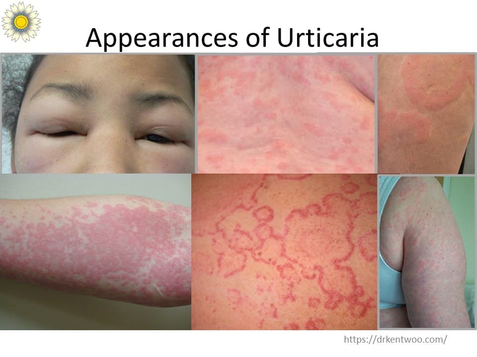 Chronic Urticaria Specialist In Malaysia Diagnosis Relief