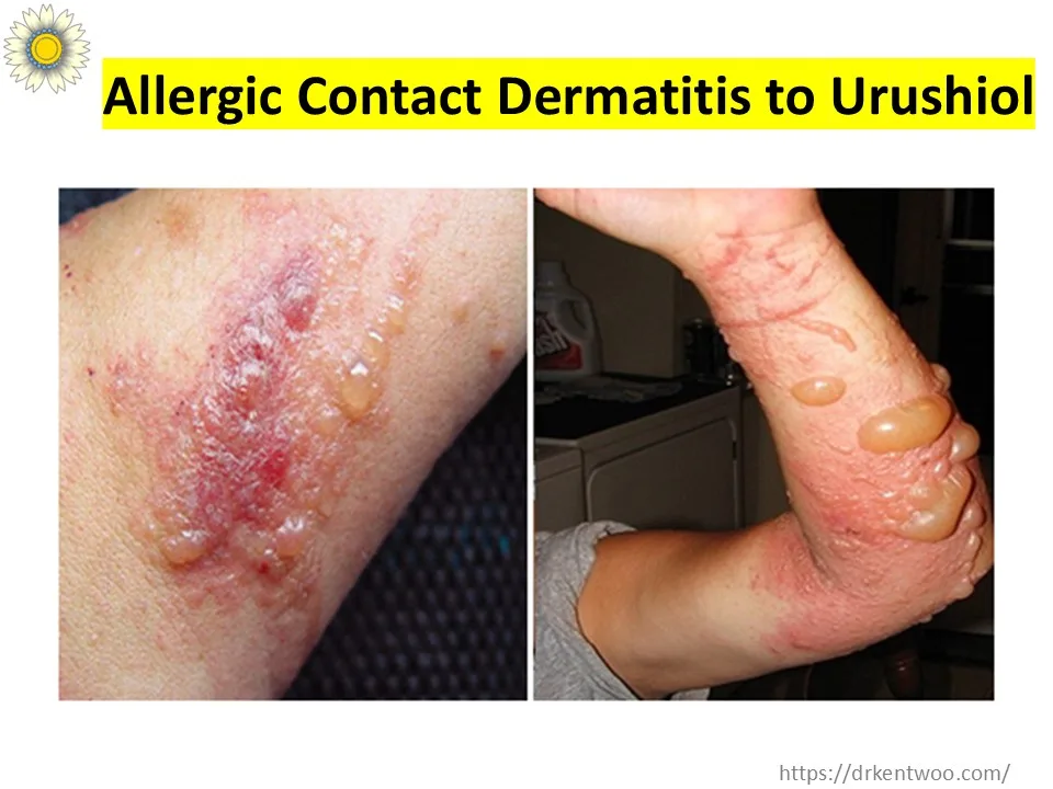 Is There Poison Ivy in Malaysia? Plants That Trigger Similar Rashes