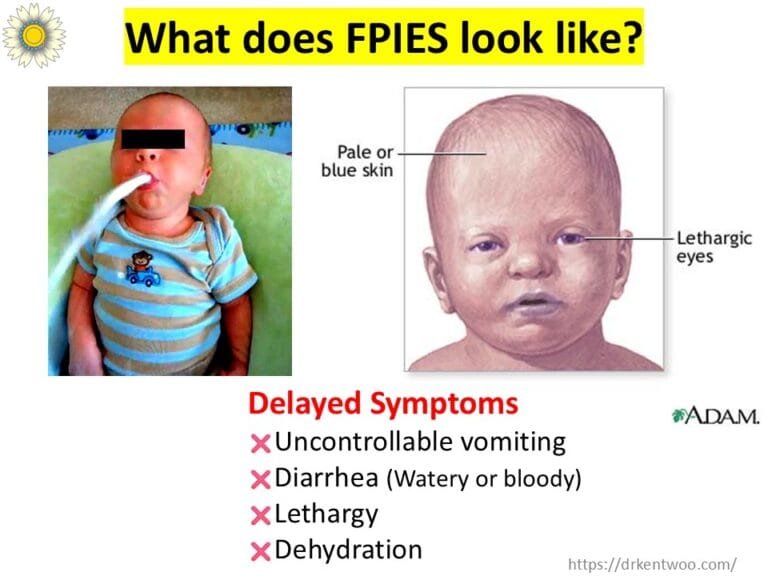 Fpies Chart FPIES: Symptoms, Triggers & How to Manage This Delayed Food Allergy