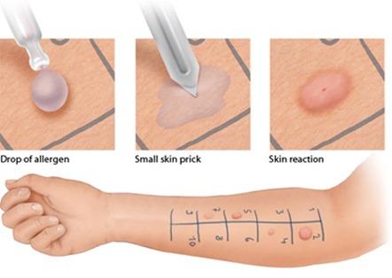 Skin testing done on arm