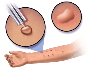 Allergy skin prick test procedure